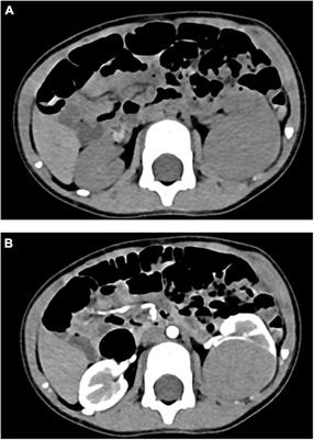 Chemotherapy Combined With Surgery in a Case With Metanephric Adenoma